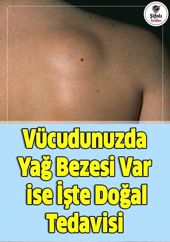 Vücudunuzda Yağ Bezesi Var ise